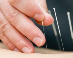 Benefícios da Acupuntura