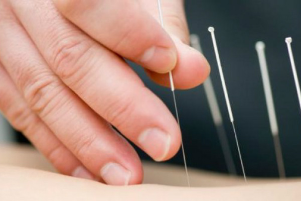 Benefícios da Acupuntura